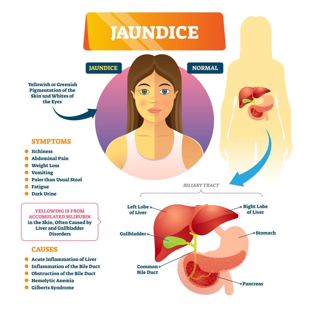 Can Diabetes Affect the Liver?