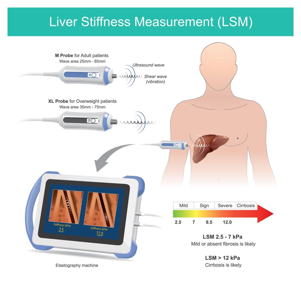 Can Diabetes Affect the Liver?
