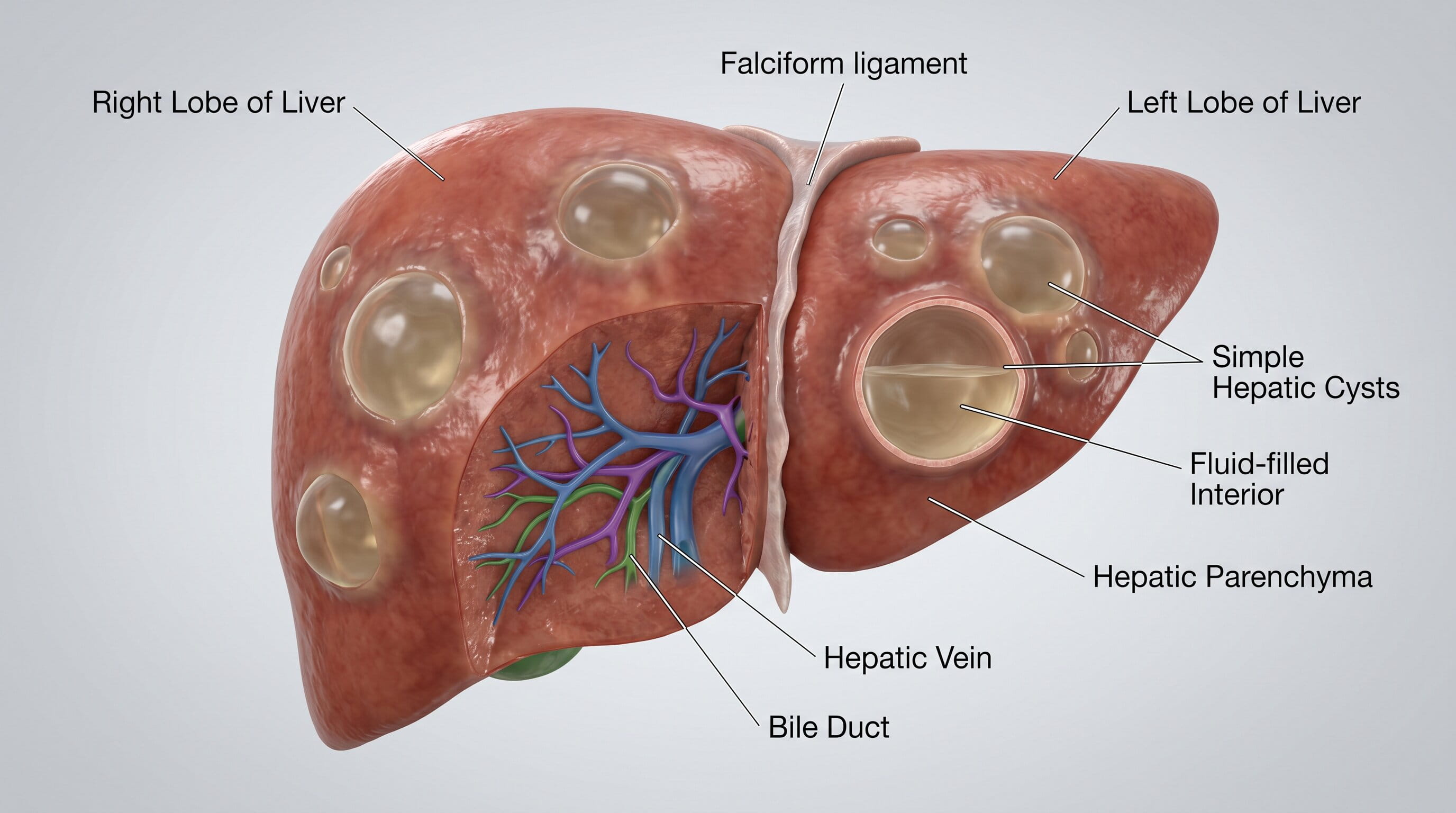 Causes of Liver Cysts: What You Need to Know
