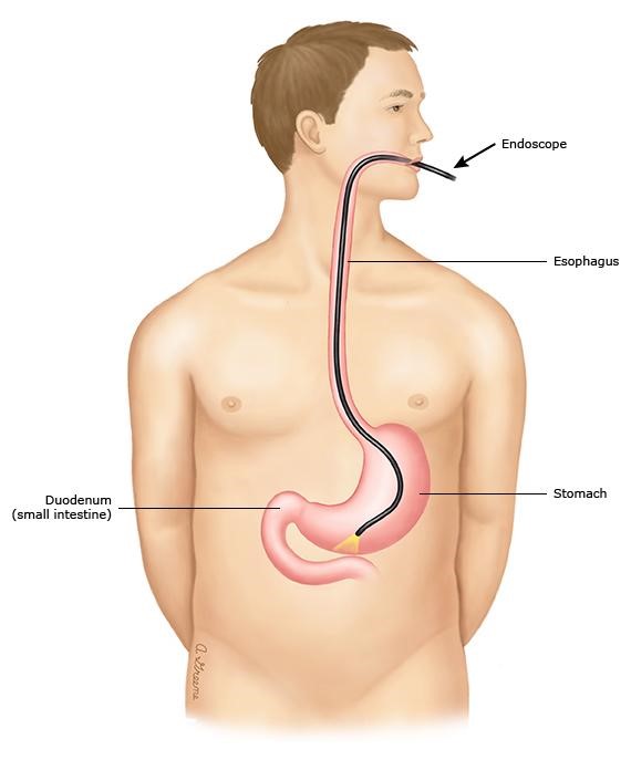 Diabetes and GERD: Is There a Link?