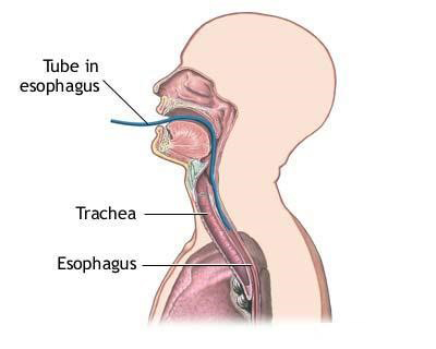 Diabetes and GERD: Is There a Link?