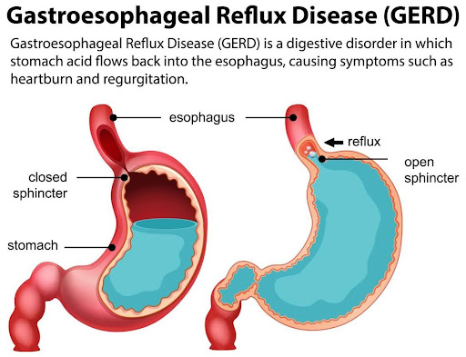 Diabetes and GERD: Is There a Link?