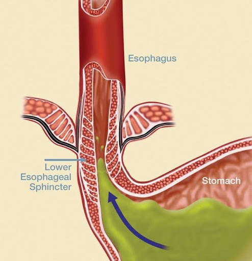 Diabetes and GERD: Is There a Link?