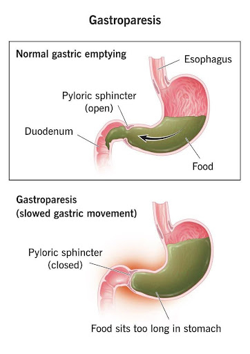 Diabetes and GERD: Is There a Link?