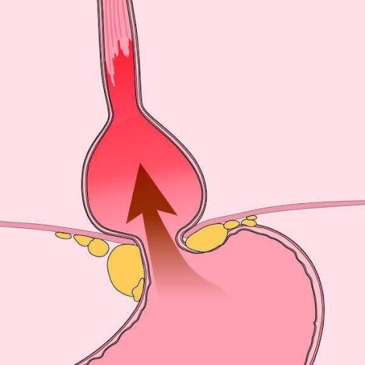 Diabetes and GERD: Is There a Link?