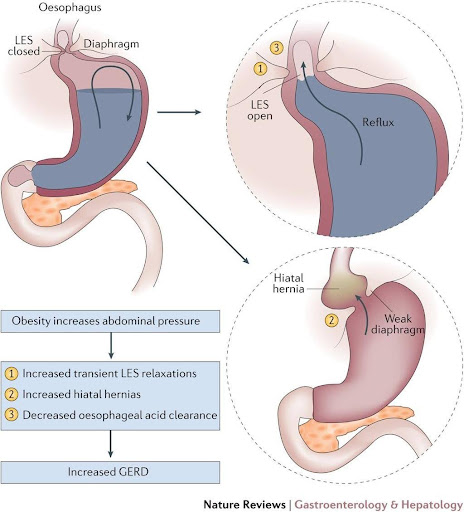 Diabetes and GERD: Is There a Link?