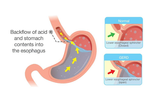 Diabetes and GERD: Is There a Link?