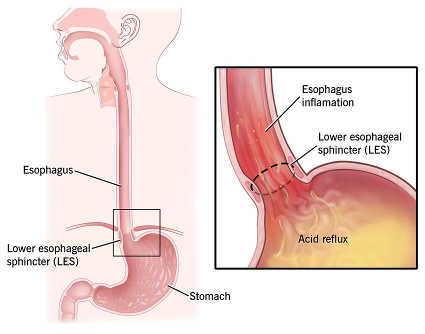 Diabetes and GERD: Is There a Link?