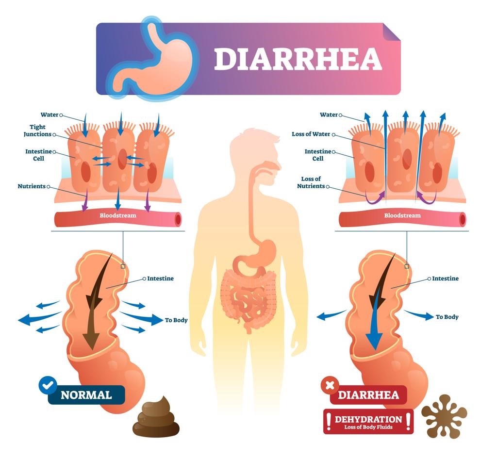 How Does Diabetes Affect the Gastrointestinal System?