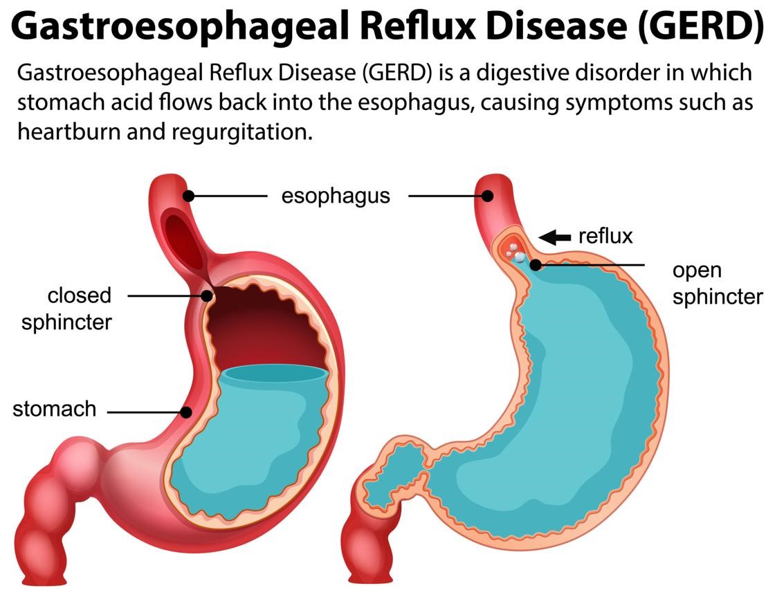 How Does Diabetes Affect the Gastrointestinal System?