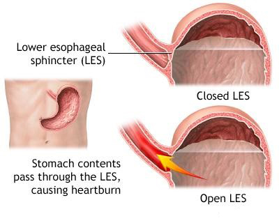 How Does Diabetes Affect the Gastrointestinal System?