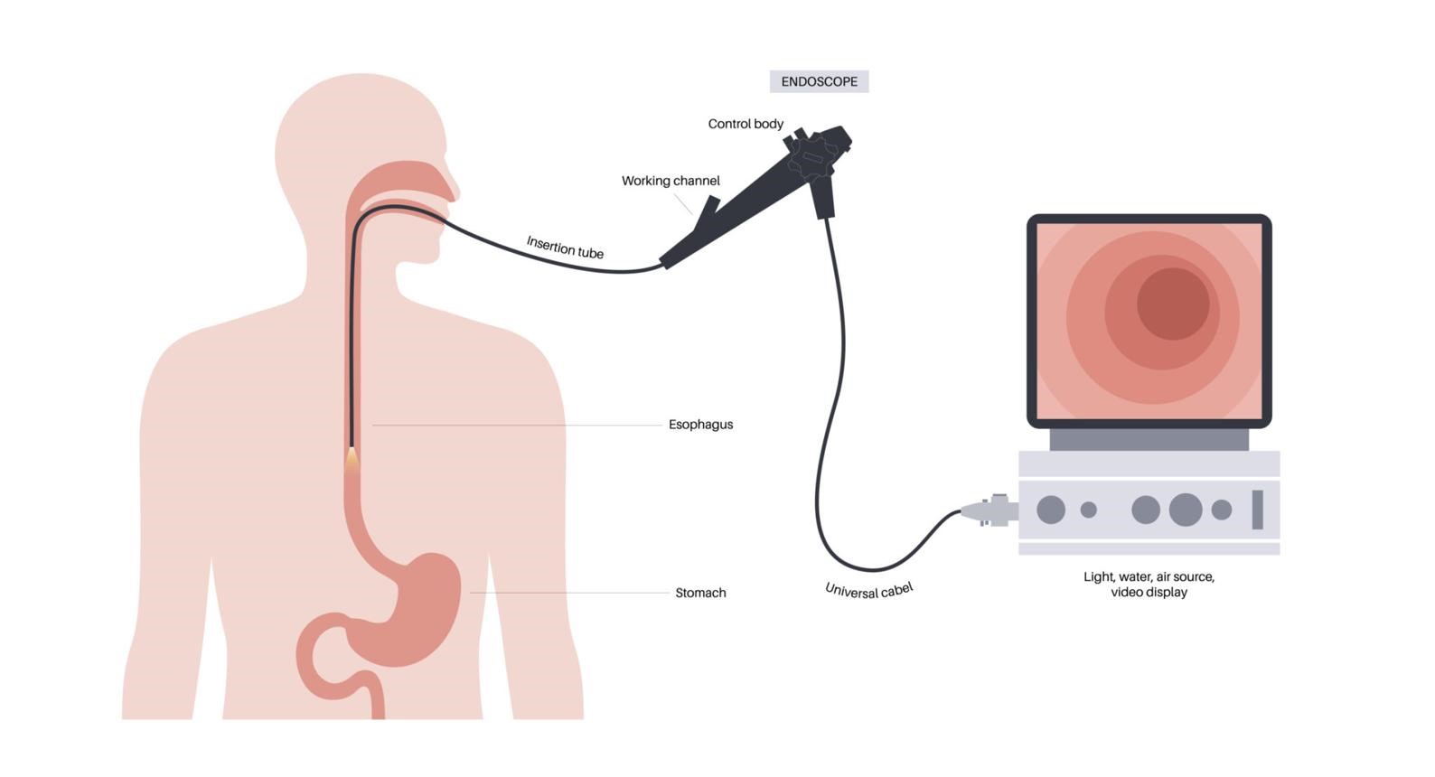 How Does Diabetes Affect the Gastrointestinal System?