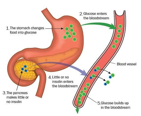 How Does Diabetes Affect the Gastrointestinal System?