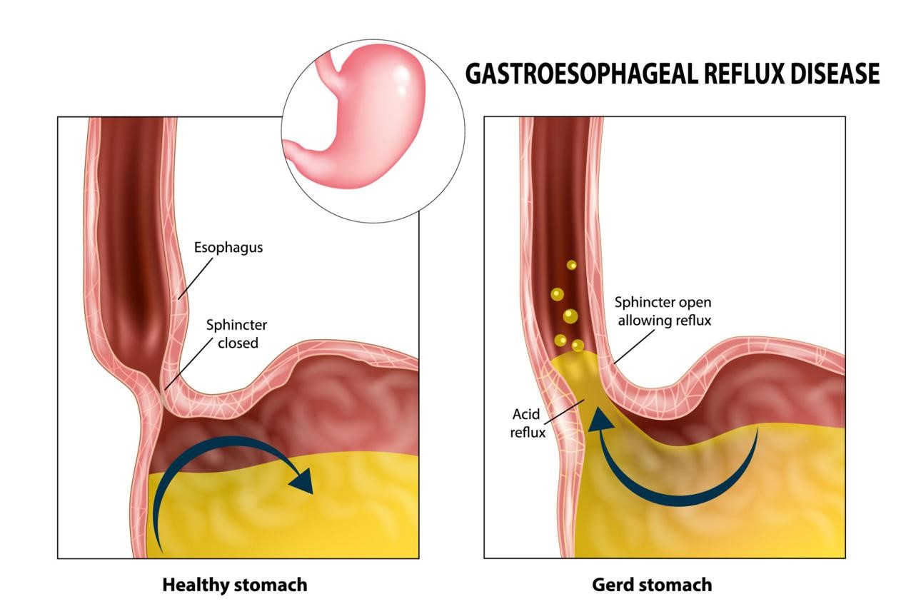 How Does Diabetes Affect the Gastrointestinal System?