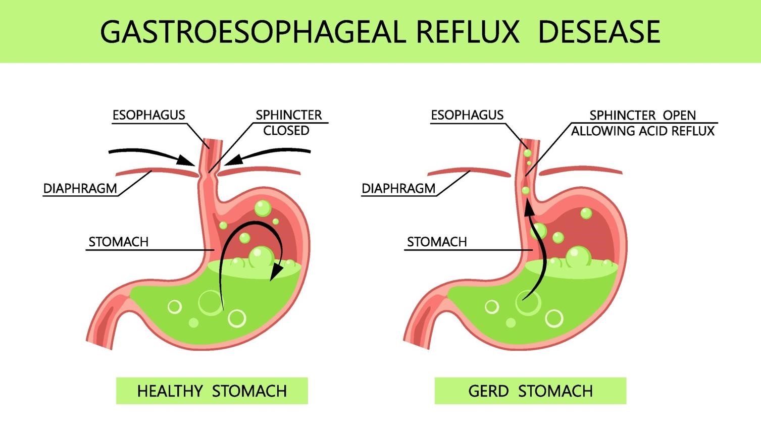 How Does Diabetes Affect the Gastrointestinal System?