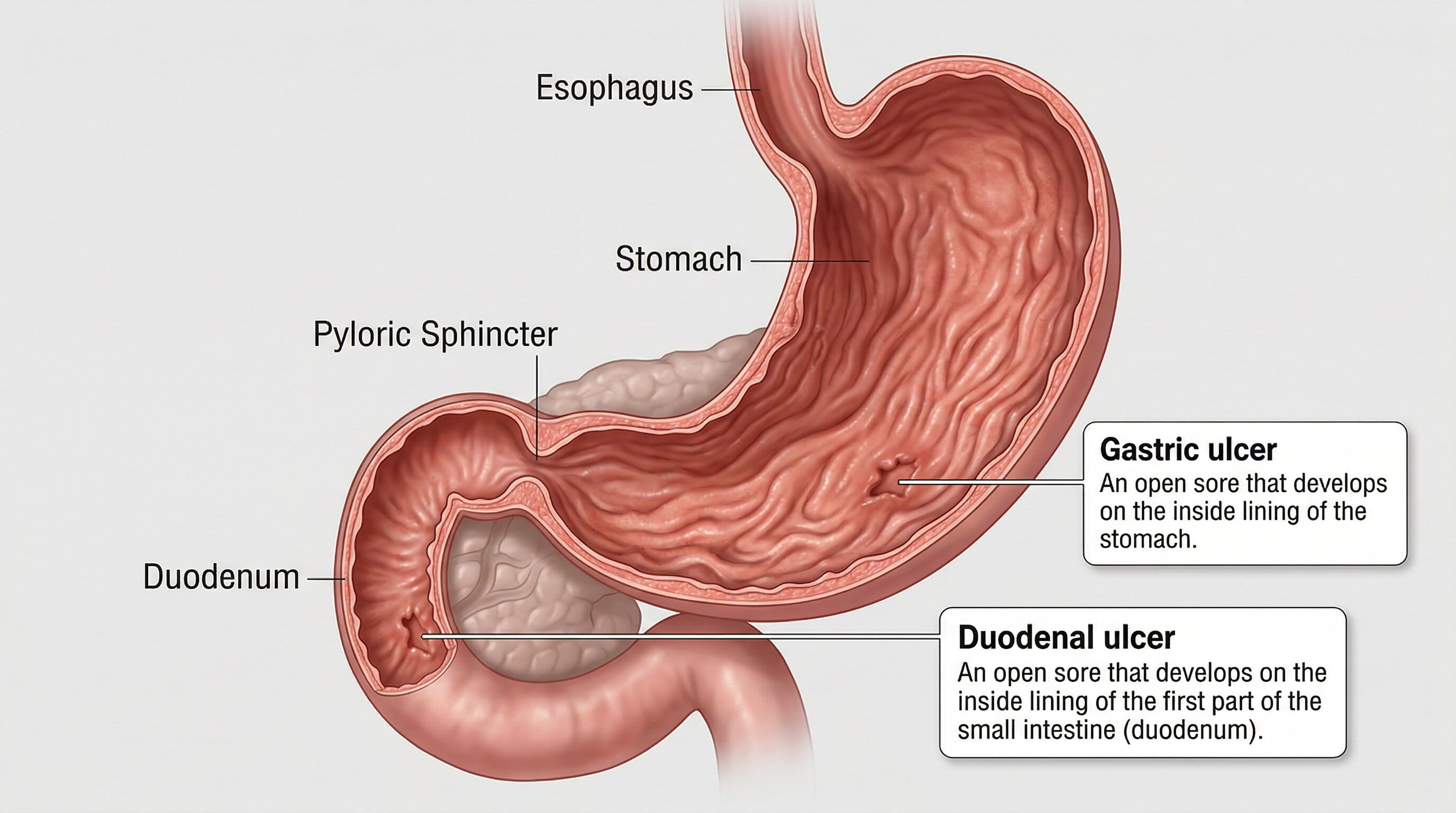 How Hematemesis Relates to Peptic Ulcers and Gastrointestinal Bleeding