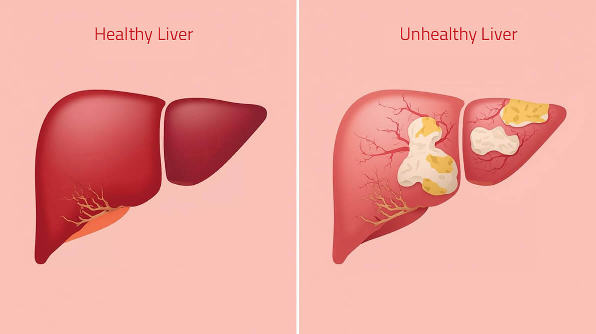 Non-Alcoholic Fatty Liver Disease (NAFLD) & Liver Health: What Jersey Village Residents Need to Know