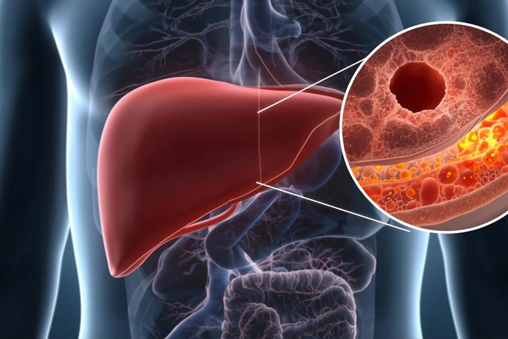 Understanding Non-Alcoholic Fatty Liver Disease (NAFLD) and How to Protect Your Liver in Katy, TX