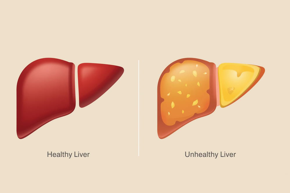 Understanding Non-Alcoholic Fatty Liver Disease (NAFLD) and How to Protect Your Liver in Katy, TX