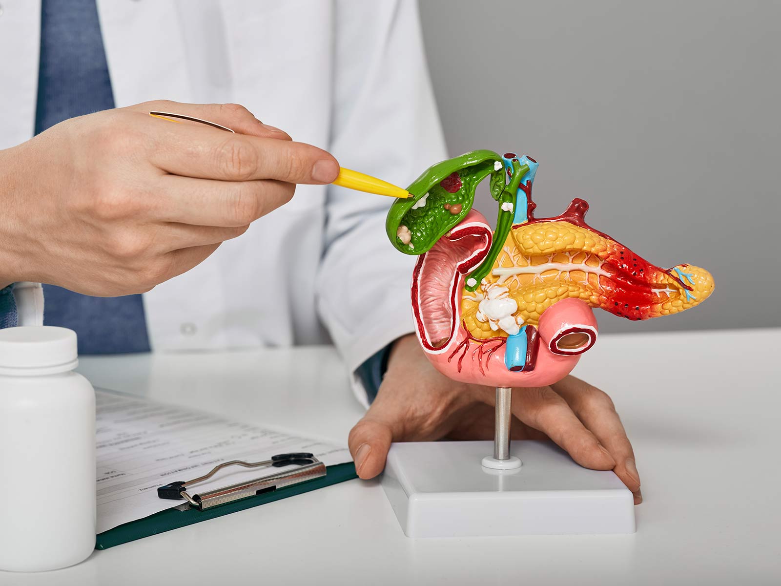 Gallstones