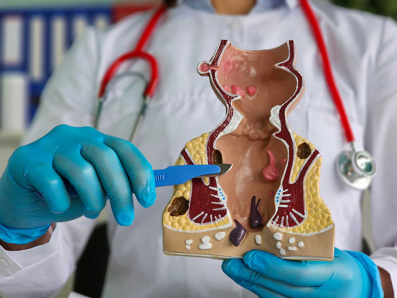 Proctitis